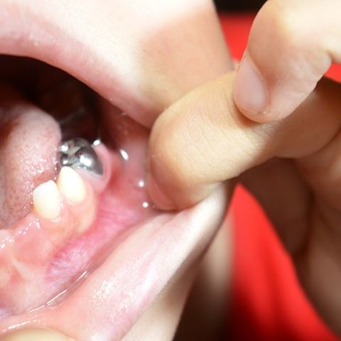 Pulpotomy
