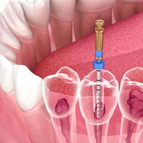 Root Canal Treatment (RCT)